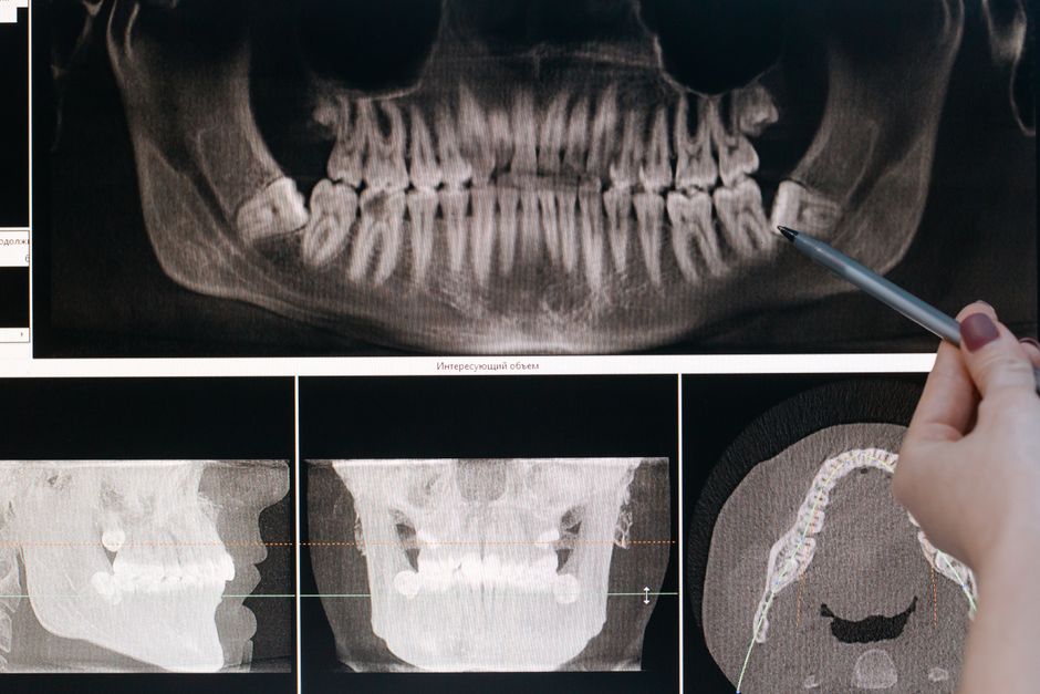 Person resting at home while recovering from wisdom tooth extraction with an ice pack on their jaw